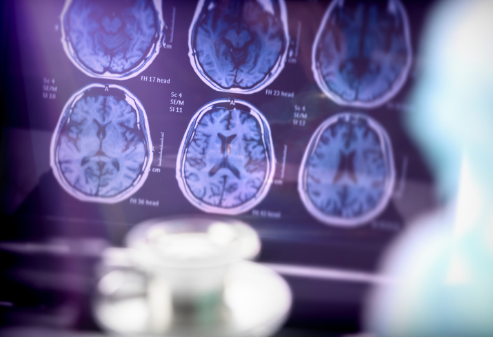 brain scan photo stimulant drugs